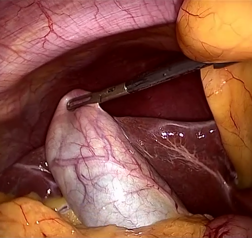 GT frame video17_01803